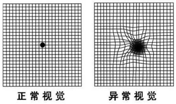 上海眼科医生姚宜：视物变形别忽视小心得致盲眼病！