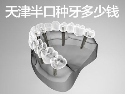 天津美国bicon全口半口种植牙费用清单 39健康 种植牙