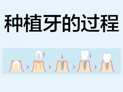 天津安装种植牙的过程需要多久