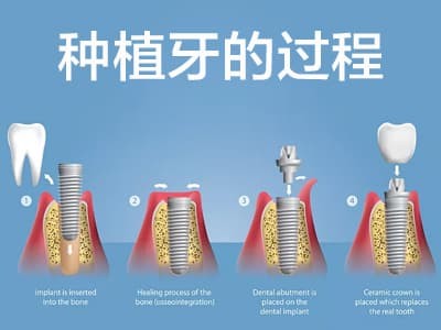 天津全口种植牙手术过程需要多久