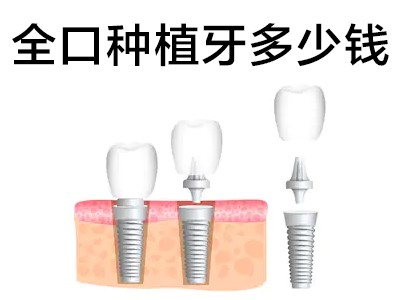 天津南开种植牙品牌及价格表