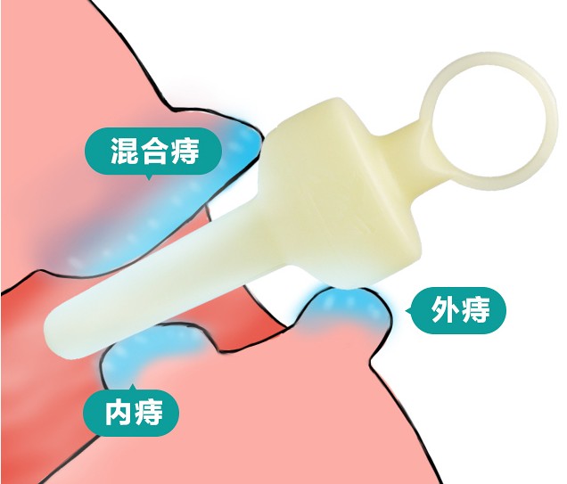 西安莲湖秦华中医医院刘明学：内痔该和那些疾病鉴别?