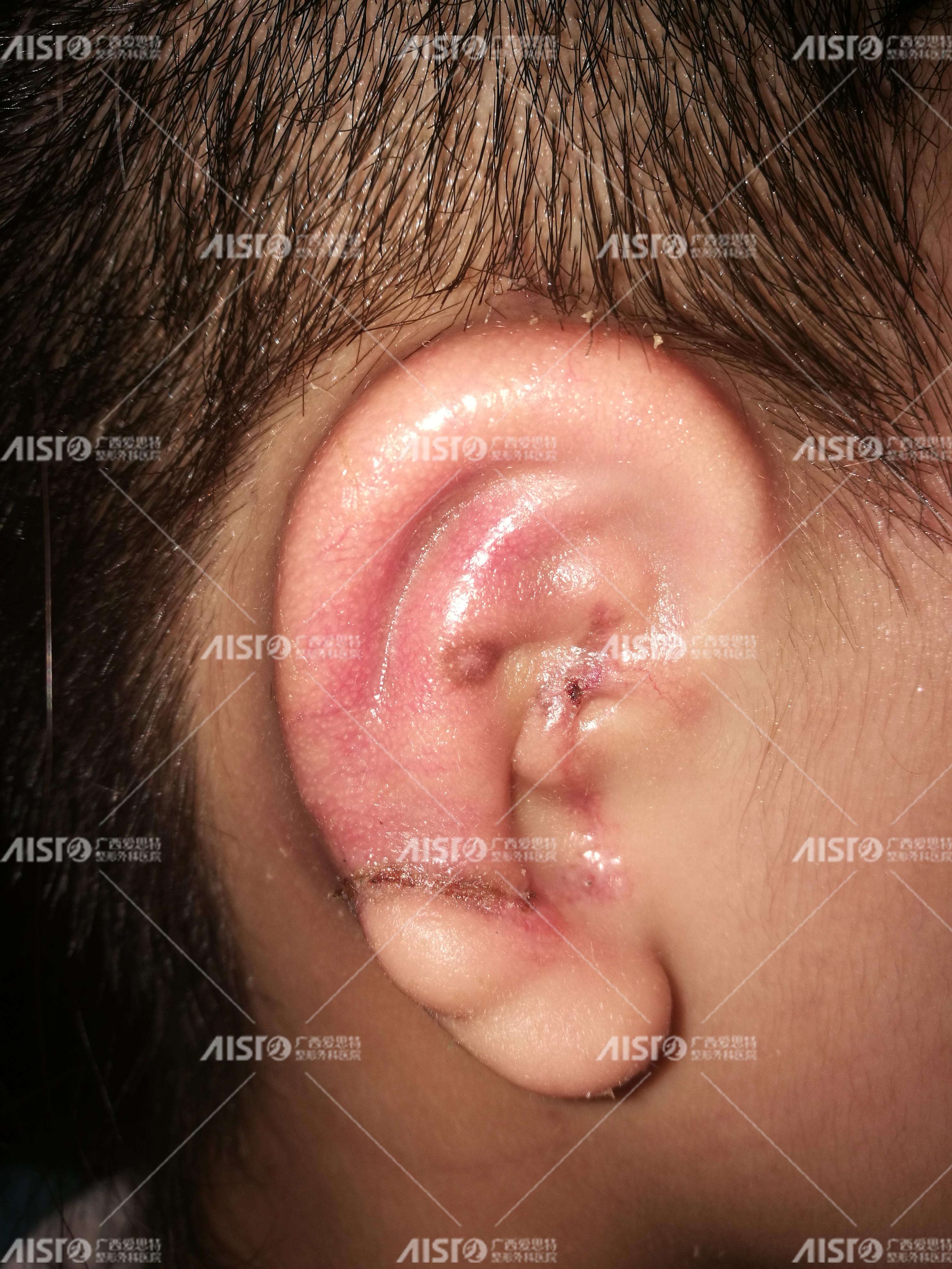 右耳畸形25年的女孩做耳再造，看看她的“新耳朵”